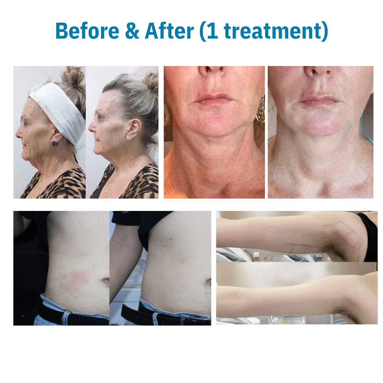 Rejuva 360 Ultra Formation Professional HIFU Machine (Body & Face) - II