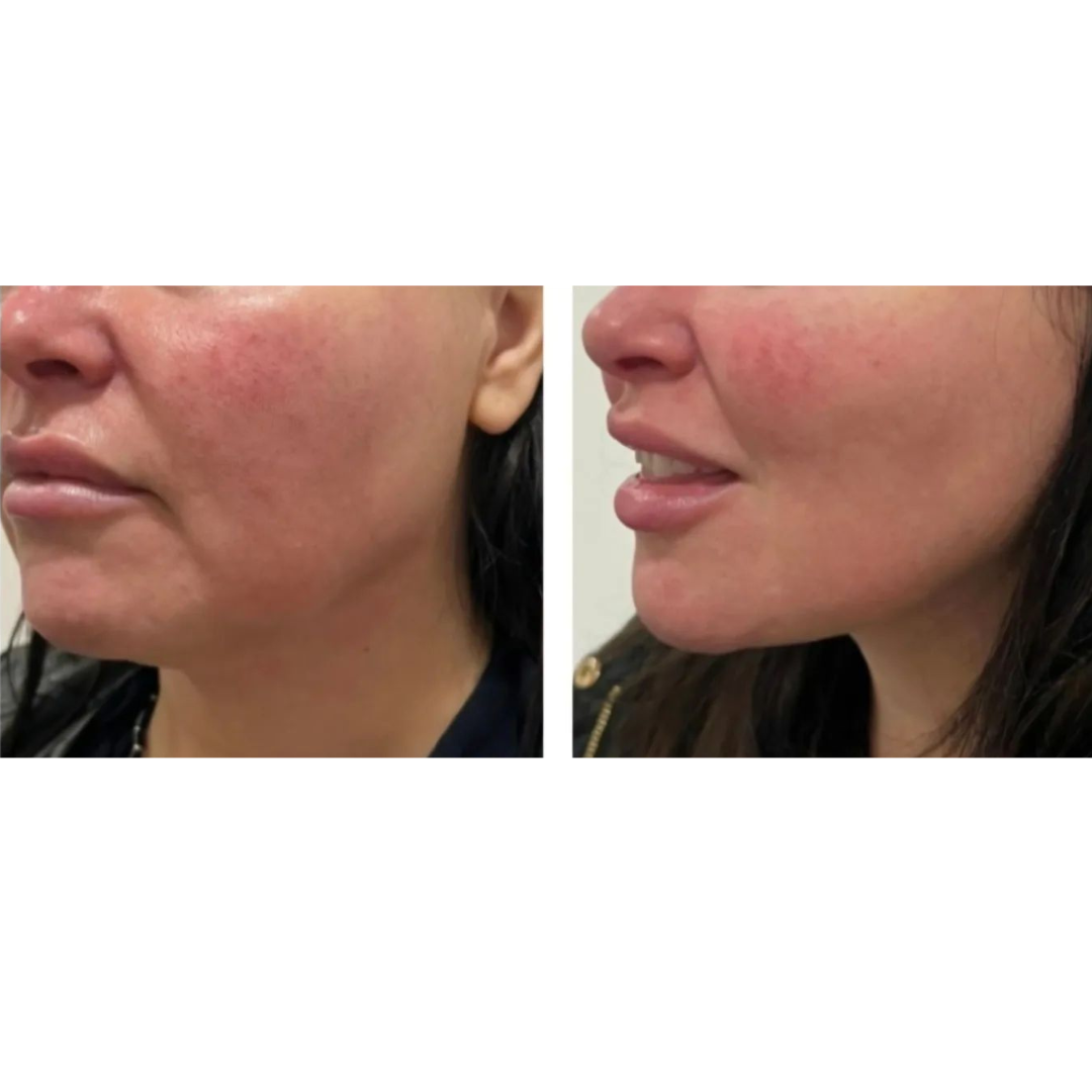 CARA PERFECTA NEO 6D Completo