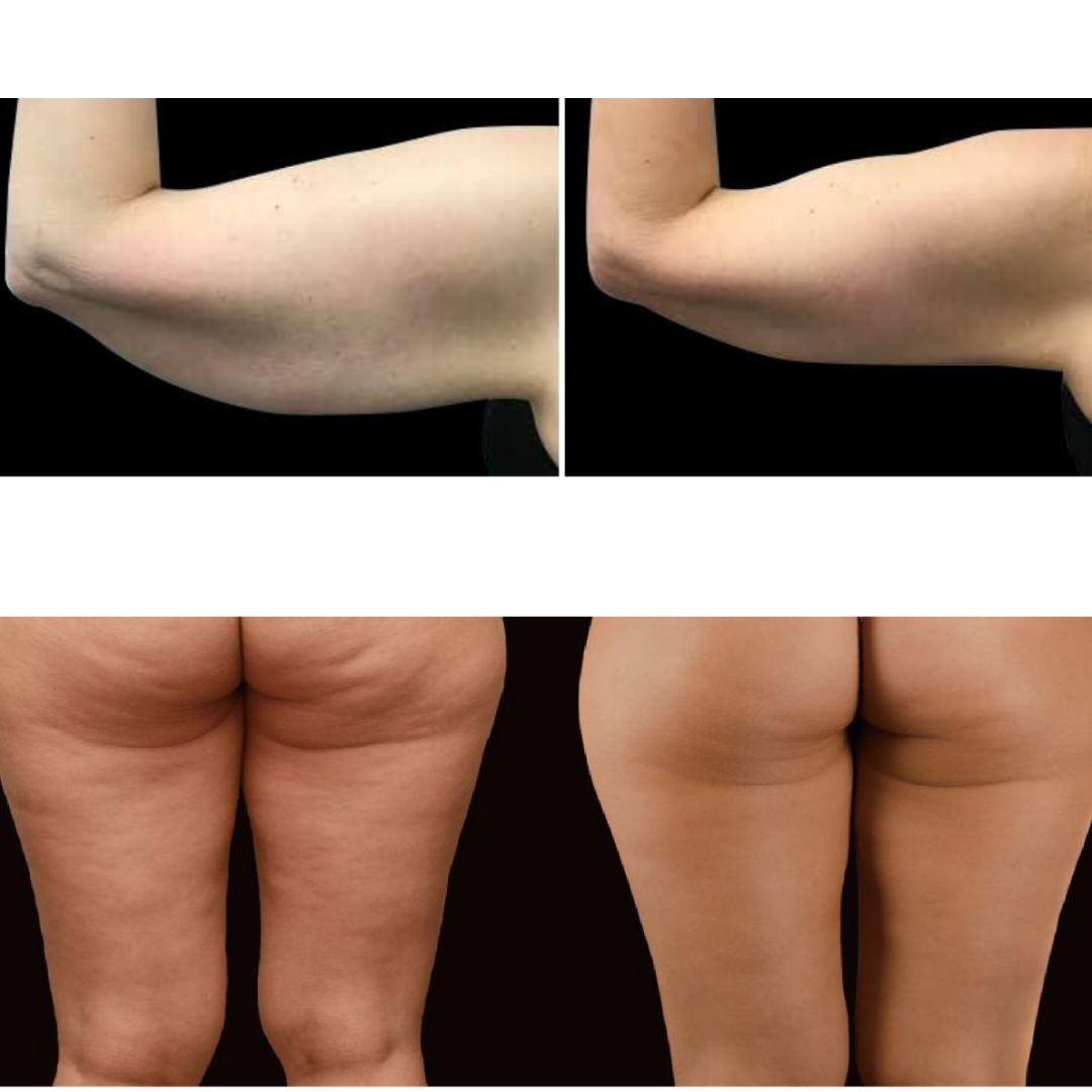 Adonis™ 30K Fat Blasting Cavitation Machine 6 in 1