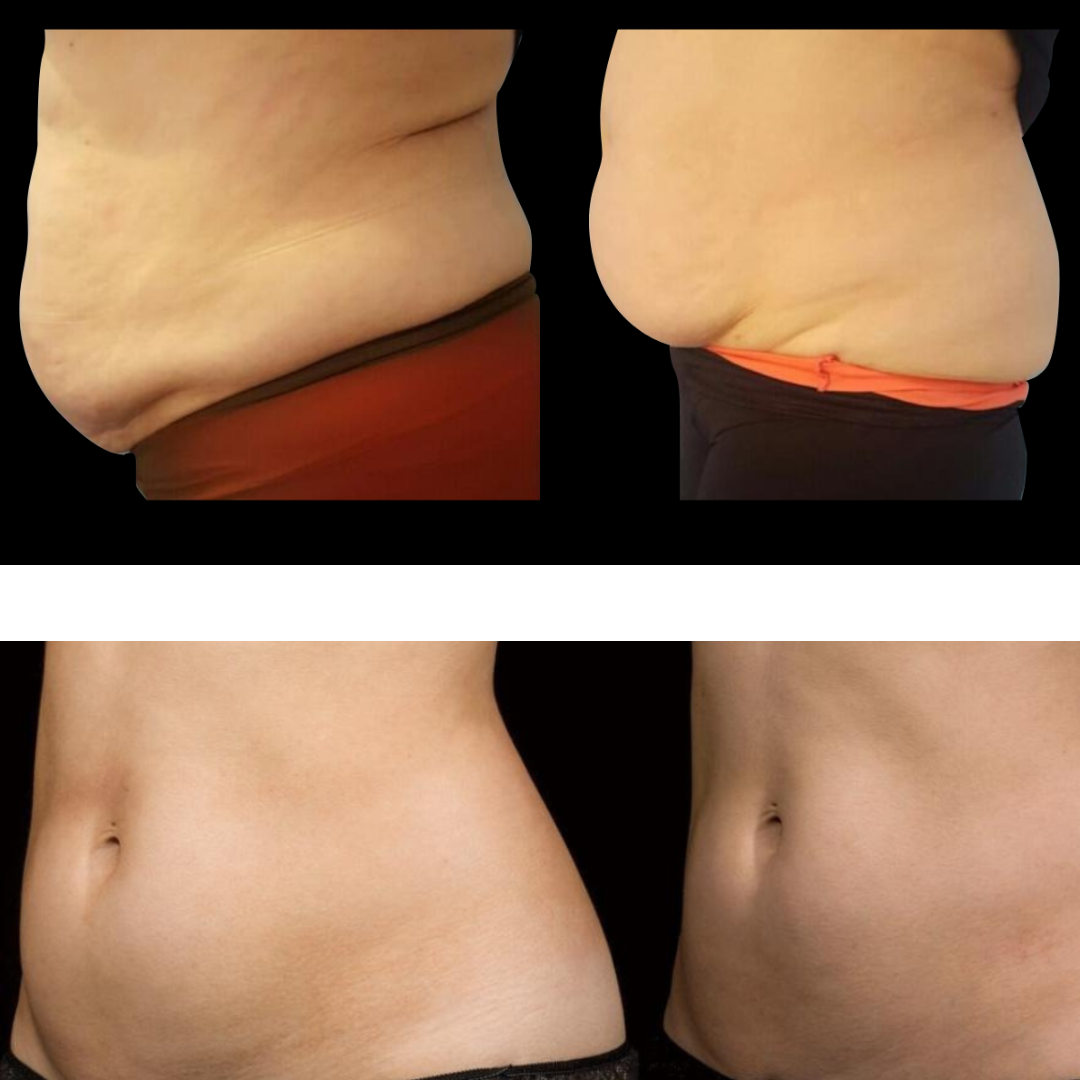 Máquina de Cavitación Adonis™ 30K para Quemar Grasa 6 en 1