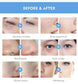 Before and After Use of  Hydrafacial Machine, remove wrinkle, acne, blackhead, dark circles, shrink pores, whiten