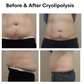 Abdominal Area Before and After Cryolipolysis Treatment 