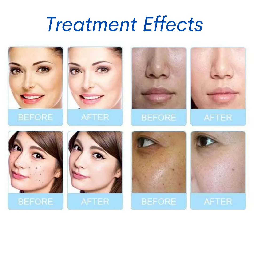 Treatment Effects Before & After Hydrafacial 