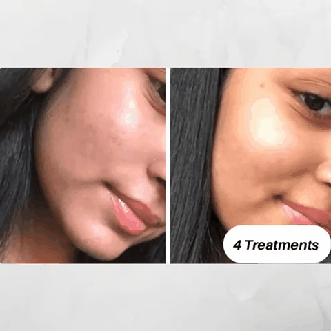 Before and After using Microdermabrasion Skin Rejuvenation Kit for 4 treatments , 5 treatments , 8 treatments , and 10 treatments 