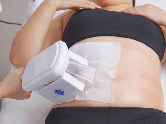Cryolipolysis machine handle is applied to abdominal area of woman’s body