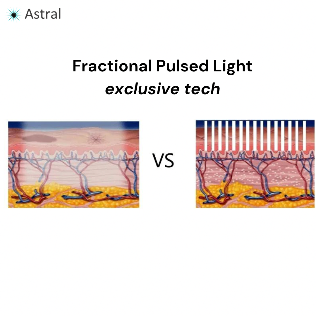 Sistema de rejuvenecimiento de la piel DermaLaze con IPL SHR y E-Light