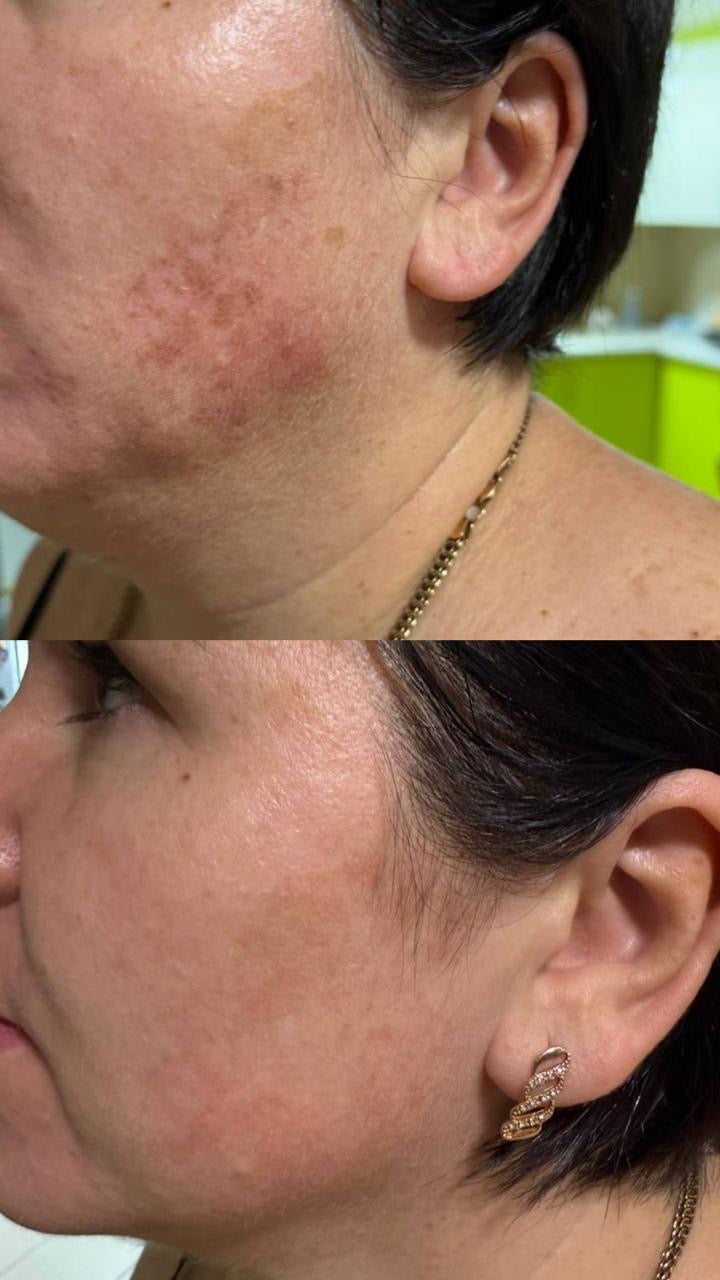 DuoSmooth™ 2-in-1 Diode Laser + IPL System