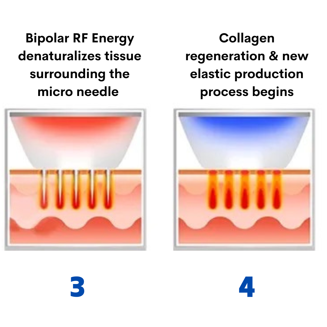 RF collagen regeneration treatment