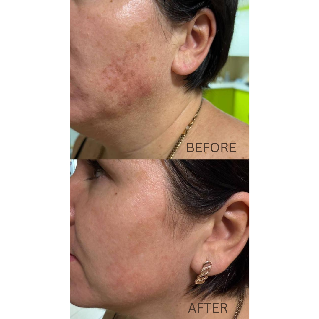 DuoSmooth™ 2-in-1 Diode Laser + IPL System