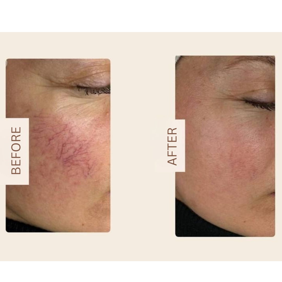 DuoSmooth™ 2-in-1 Diode Laser + IPL System