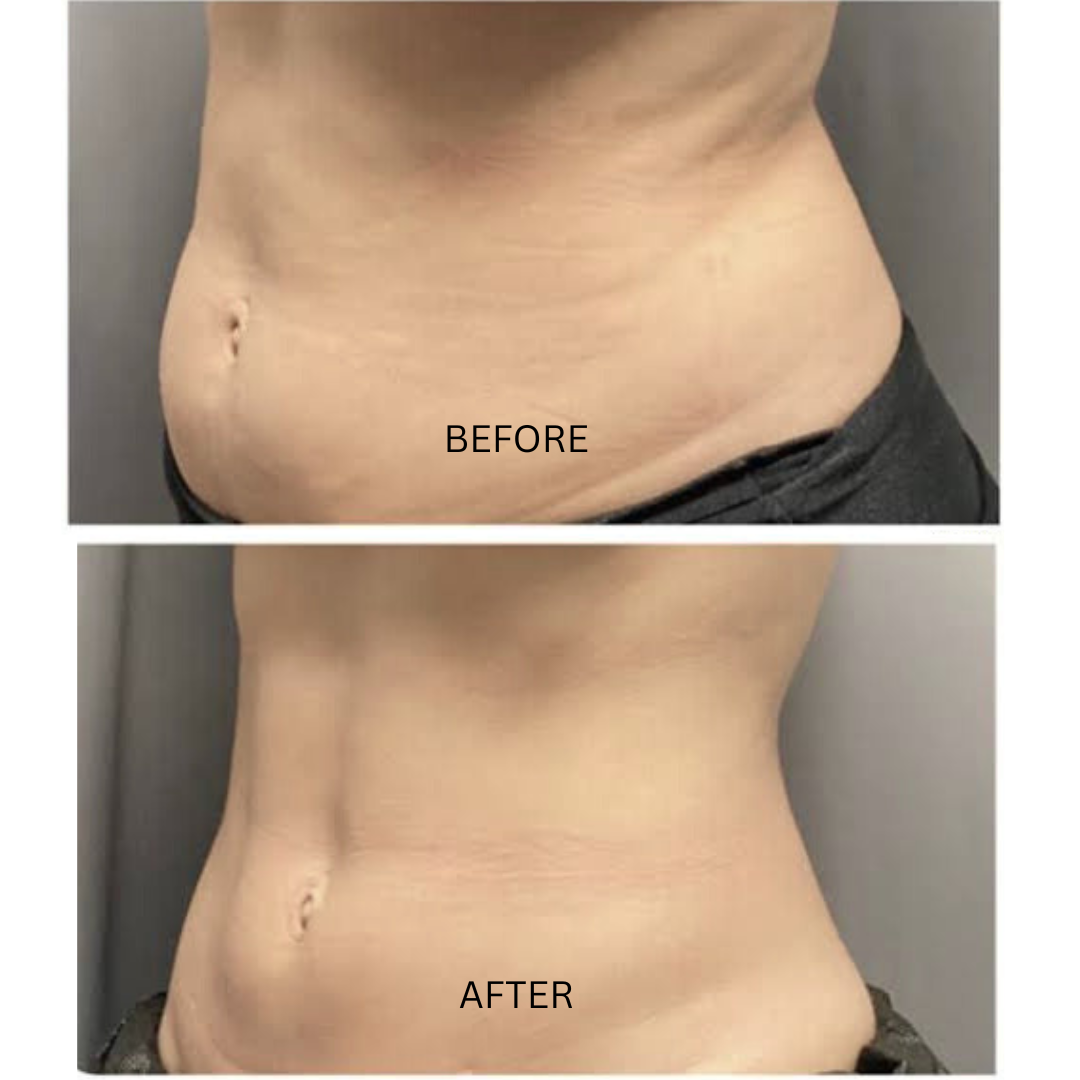 Profesional PERFECT SHAPE® NEO PLUS (Cuerpo y Rostro)