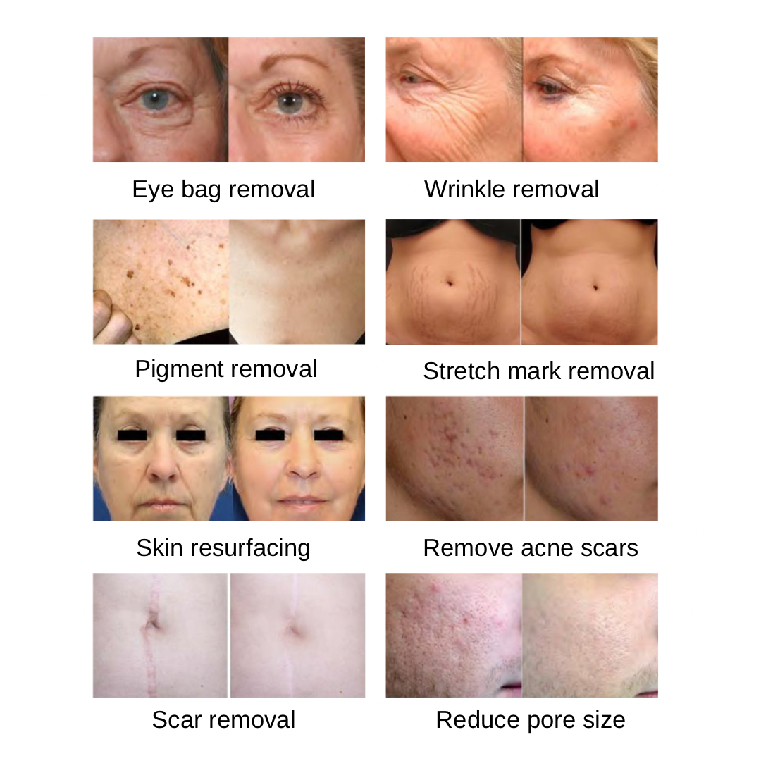 Láser Co2 Fraccionado Laser Diodo Para Manchas Cara Láser Co2