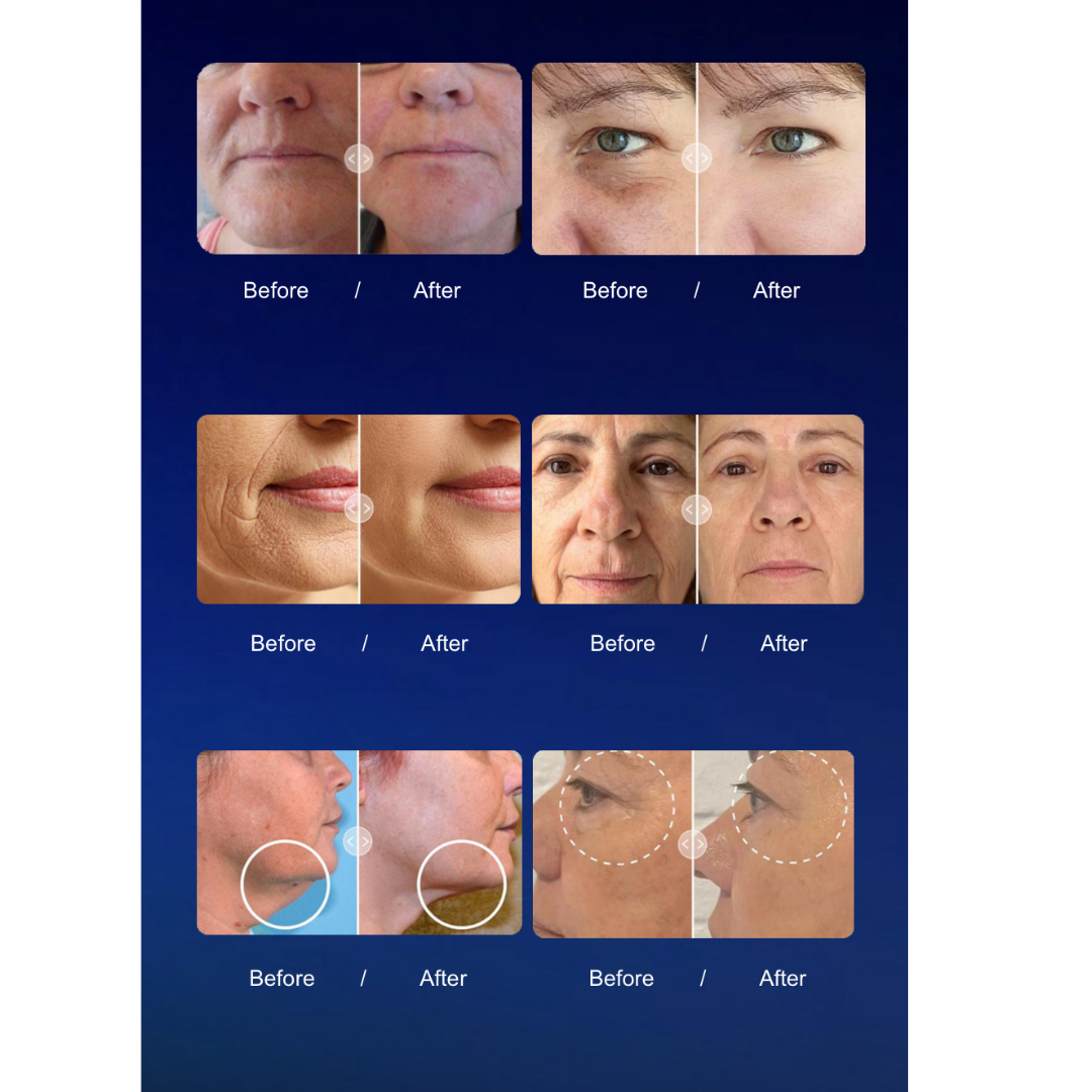 Rejuva 360 Ultra Formation Professional HIFU Machine (Body & Face) - II