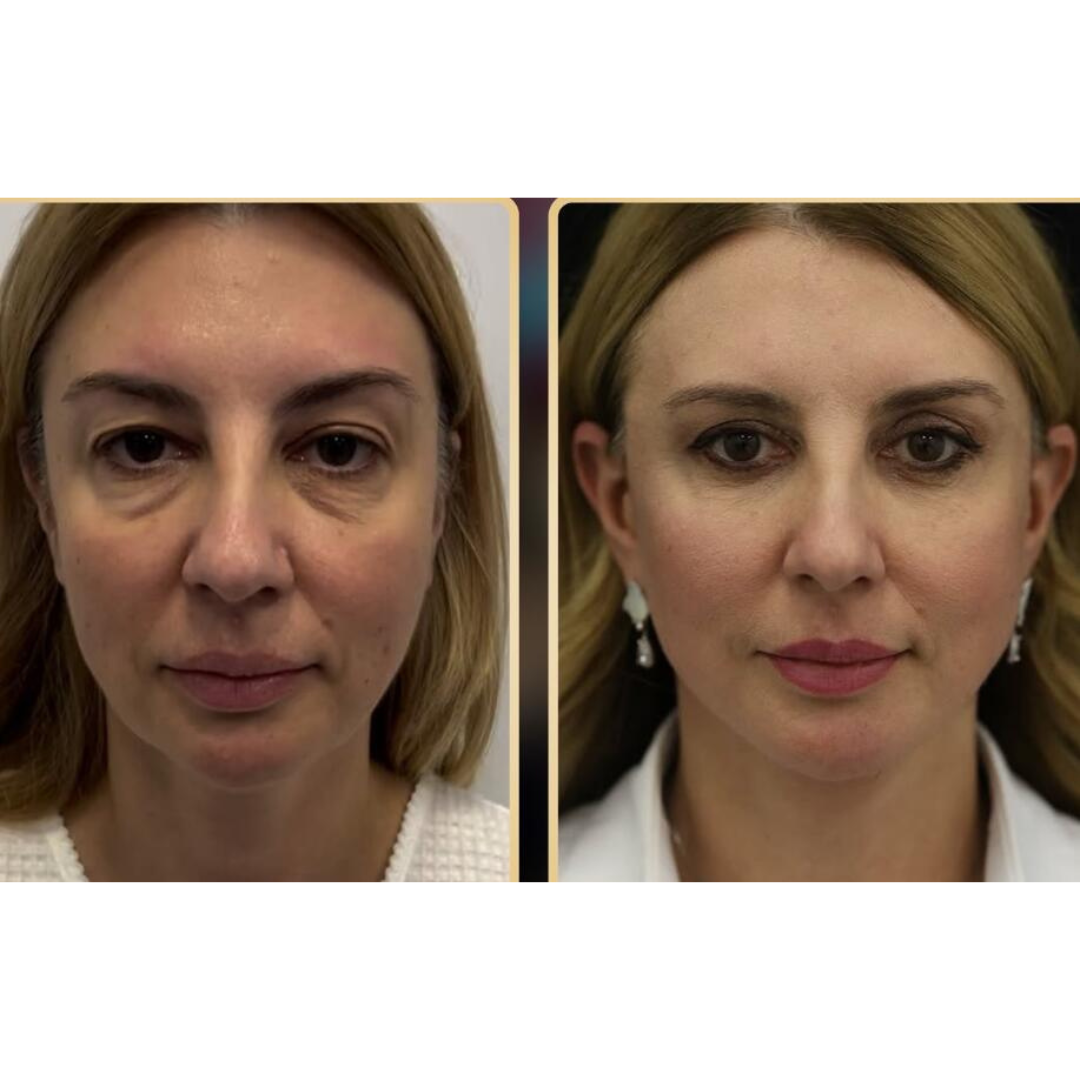 Profesional PERFECT SHAPE® NEO PLUS (Cuerpo y Rostro)