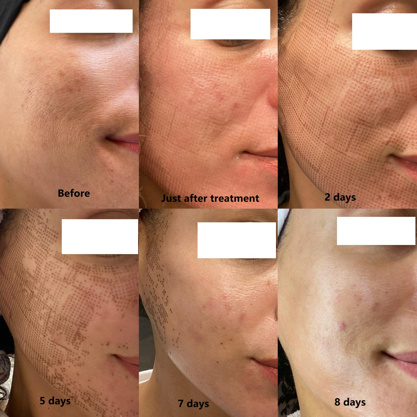 Rejuvenecimiento Facial Láser Co2 Fraccionado Precio Por Sesión