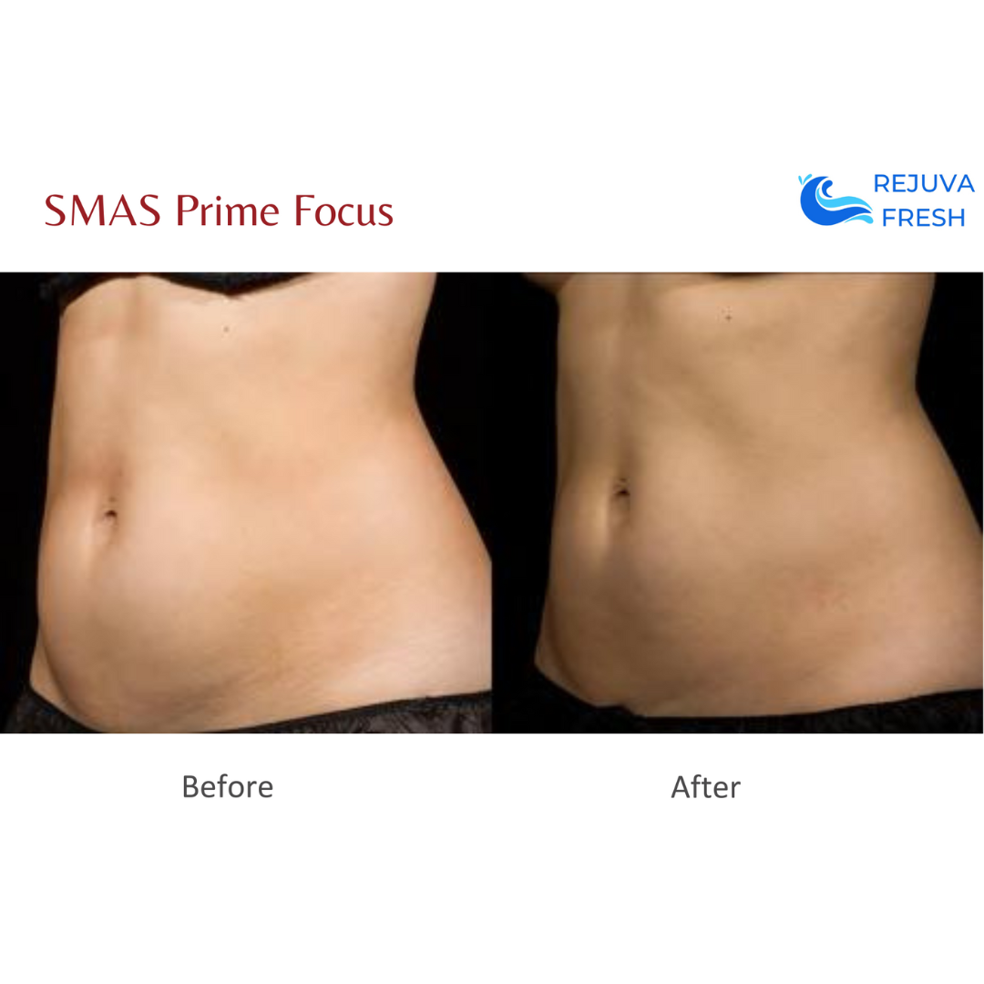 SMAS Prime Focus Professional HIFU Machine for Body & Face