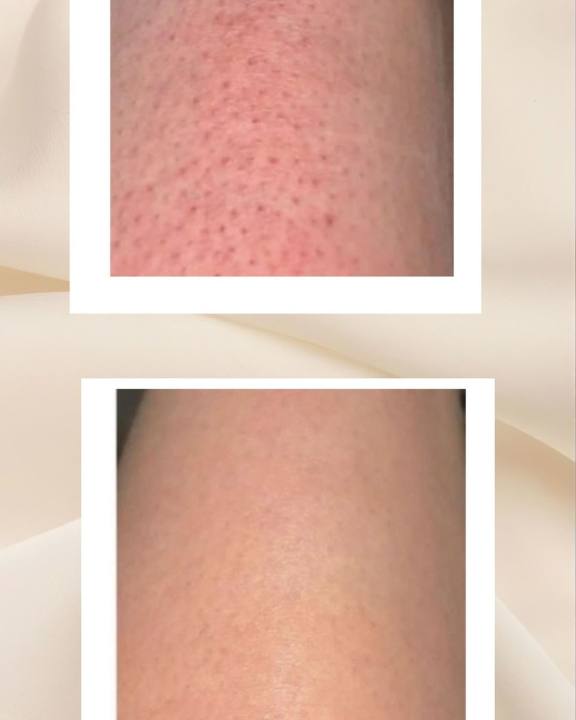 DuoSmooth™ 2-in-1 Diode Laser + IPL System