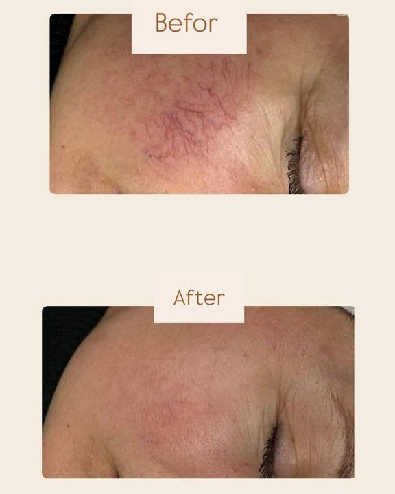 DuoSmooth™ 2-in-1 Diode Laser + IPL System