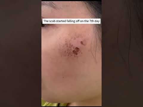 APEX™ 10D Professional Intense Pulsed Light System