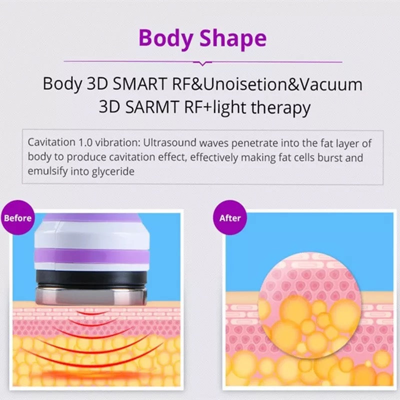 Body Shape Before and After Unoisetion RF Cavitation and Vacuum 
