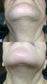 Chin and neck, before and after laser hair removal treatment 