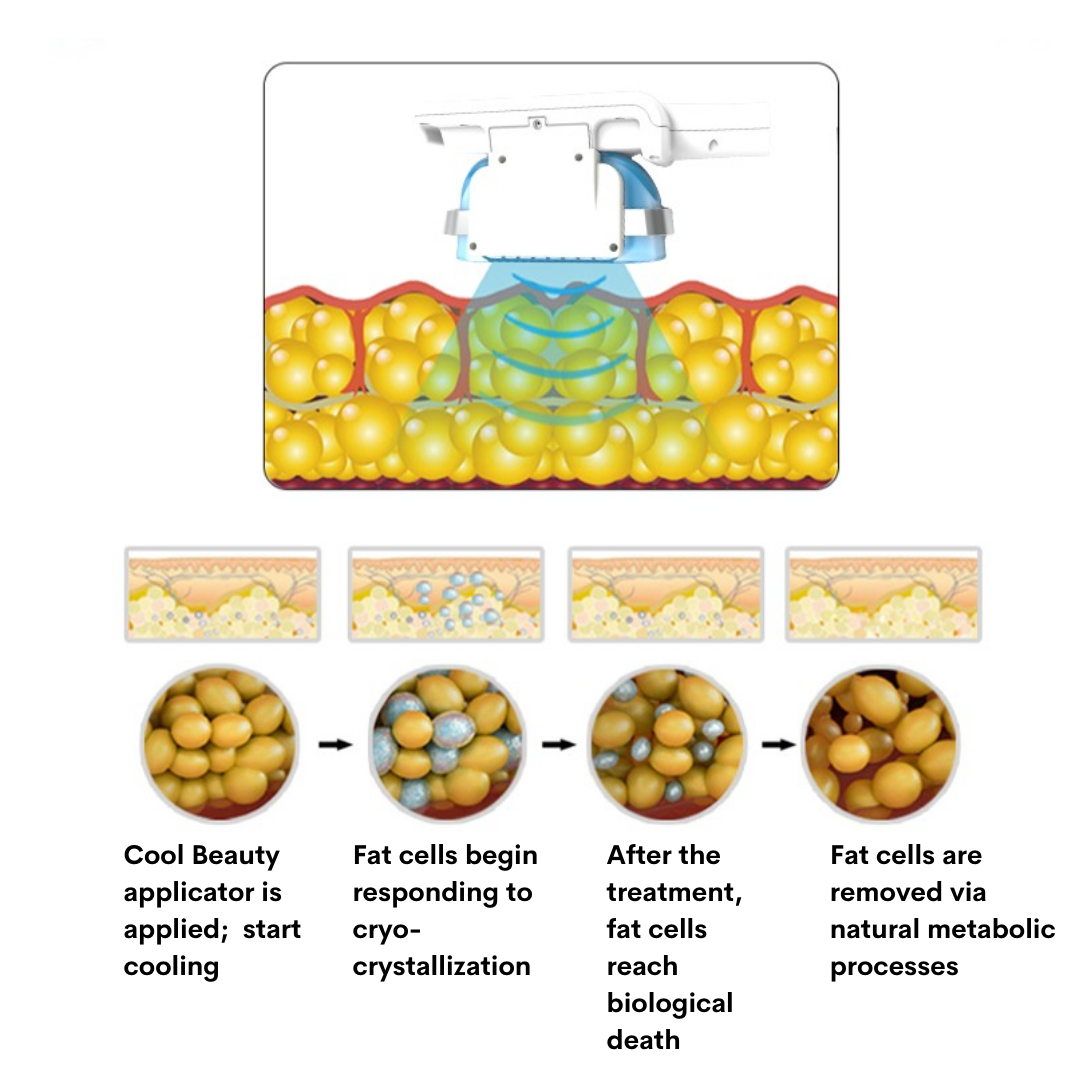 Fat cell destruction process caused by cryotherapy machine
