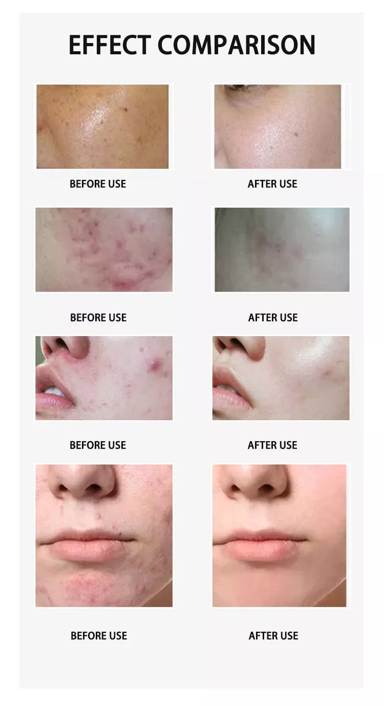 Effect comparison of facial skin before and after using hydrafacial machine