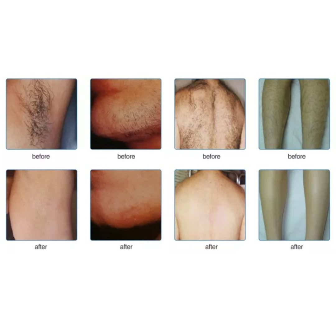 Before and after IPL hair removal  treatment on Underarms, chin back, legs