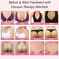 Before and After Vacuum Therapy Machine Treatment, Breast Lift, Butt Liff, Face Lift