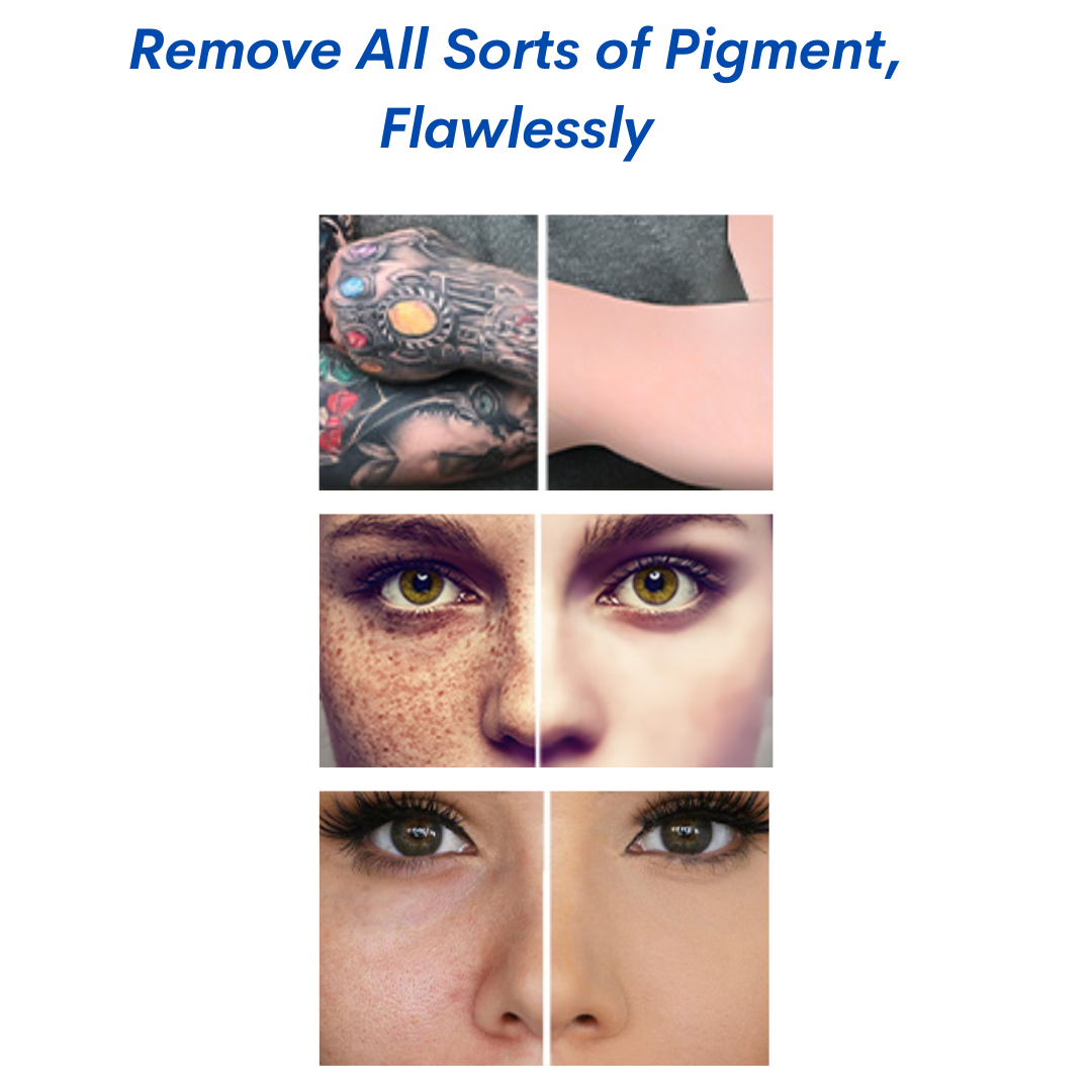 pigment removal