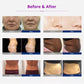 Before and after using Unoisetion Cavitation Machine on different body parts including face and stomach 