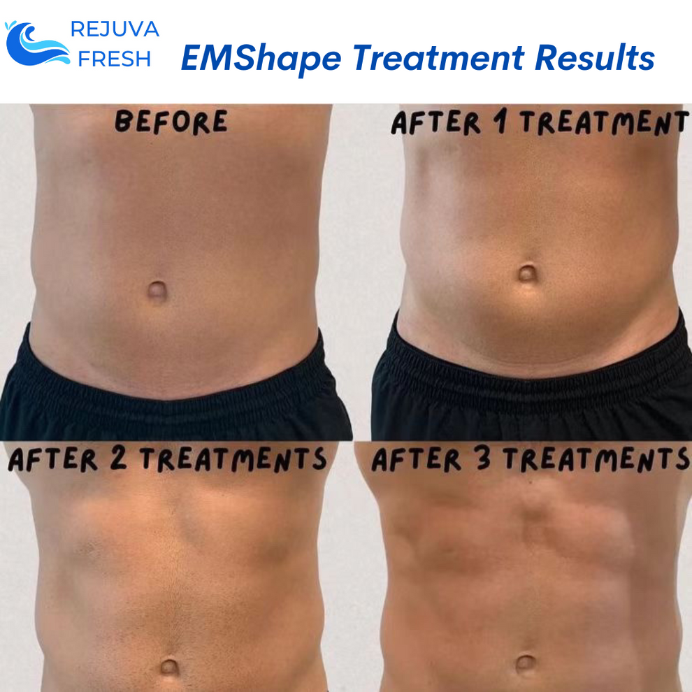 EMShape® Body Contouring Machine Professional | Best EMS Sculpting ...