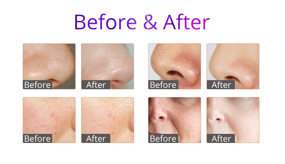 Skin of nose, cheek and face, Before and after using Hydra Facial Machine