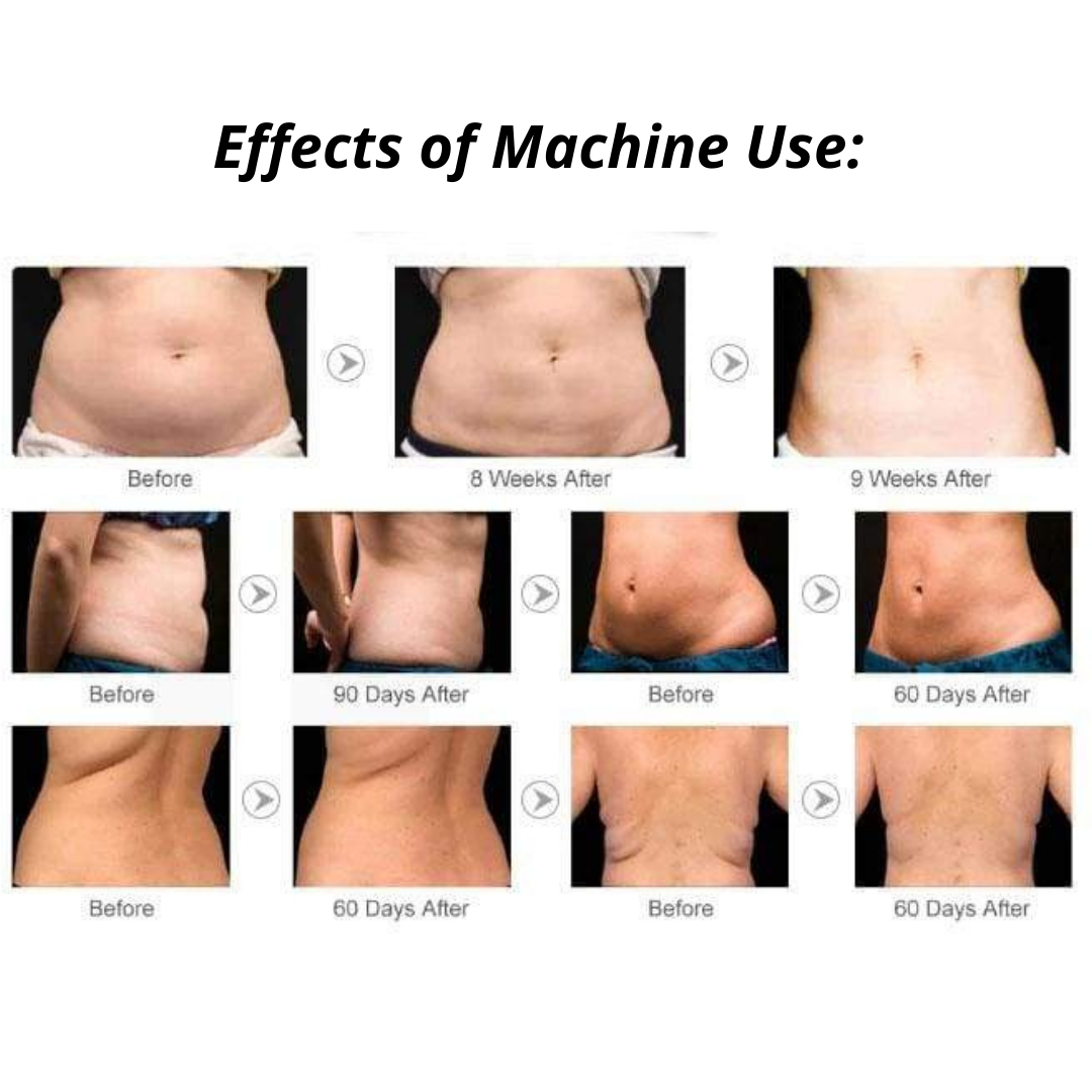 9 in 1 Lipo Cavitation Machine Before and After Effect on Stomach and Back