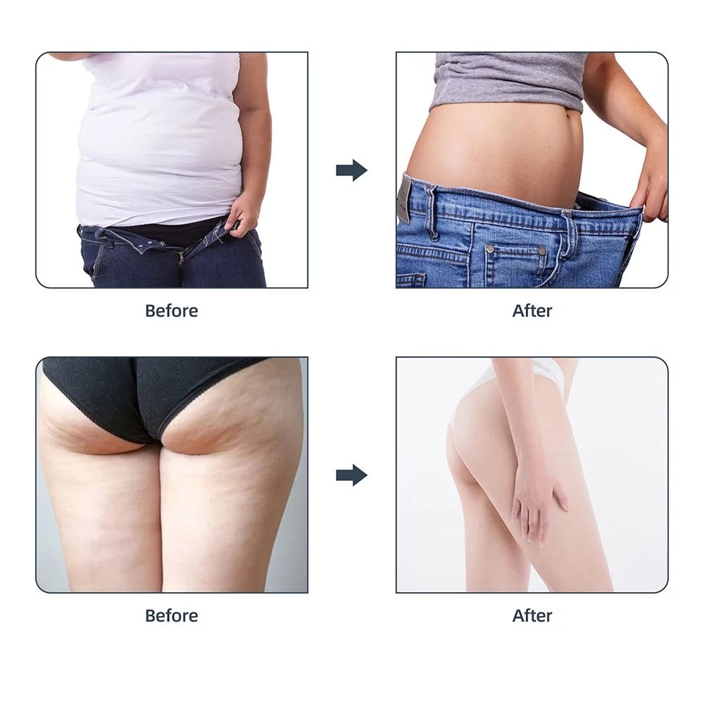 Body waist and buttocks before and after using 40k Cavitation RF Body Slimming Machine