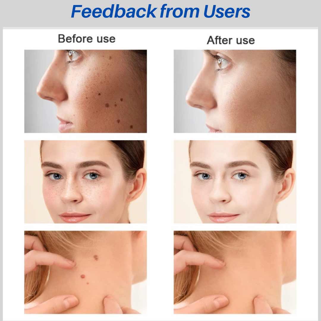 Before and after, Feedback from users of Skin Tag Removal Kit, Plasma Pen