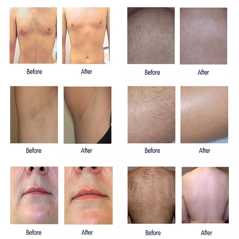 before and after using Laser hair removal 