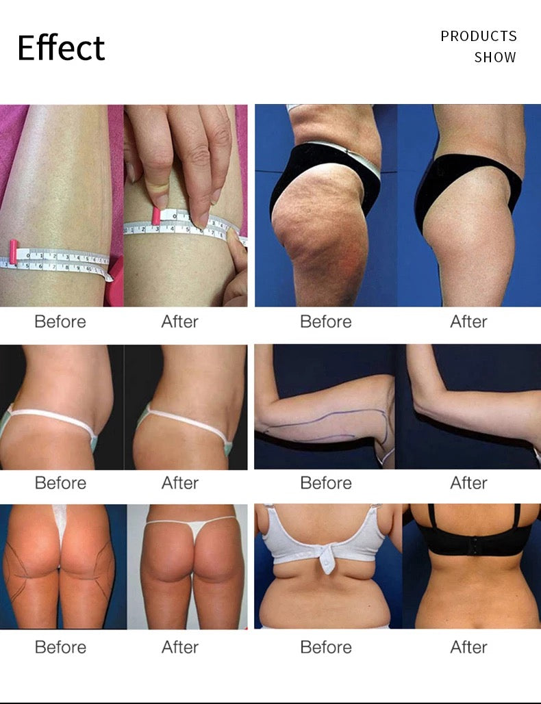 80k Cavitation Machine Before and after effects on various body parts