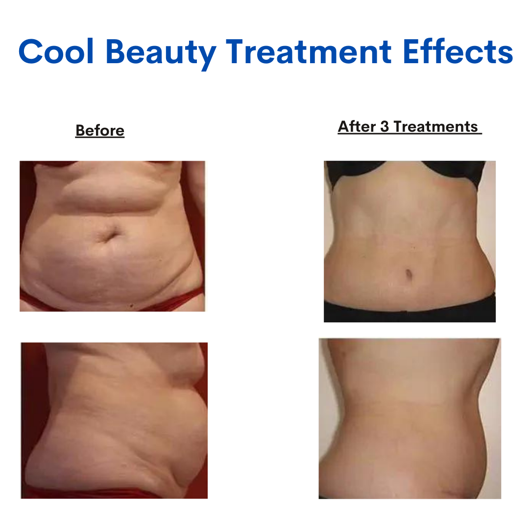 Abdomen before and after Treatment with Cryotherapy Machine
