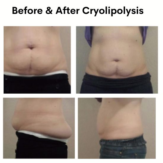 Cryotech Cryolipolysis Weight Loss Machine Best Cryotherapy Fat